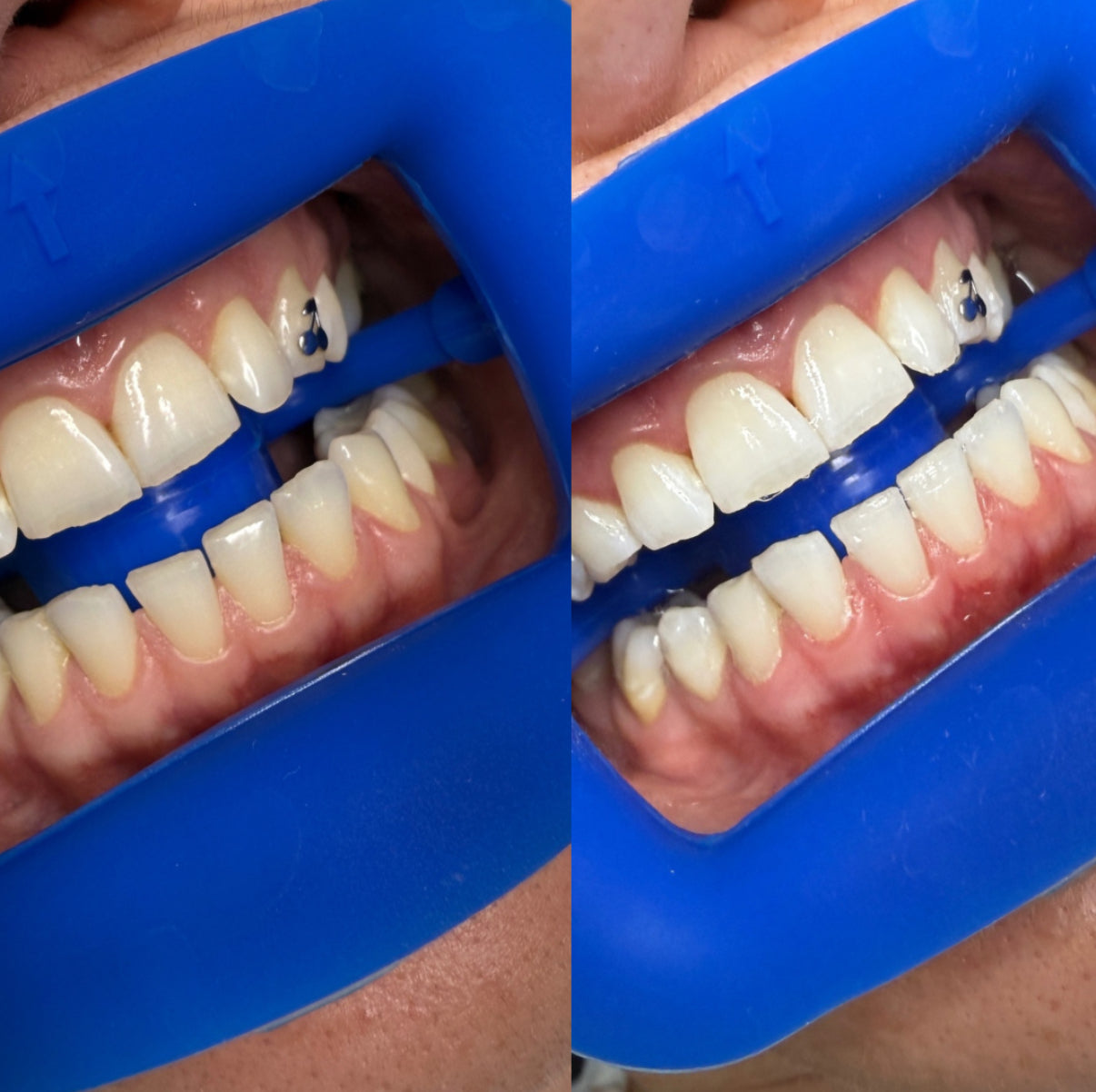 teeth whitening pens, professional whitening pens Australia, hydrogen peroxide whitening pen, teeth whitening supplies