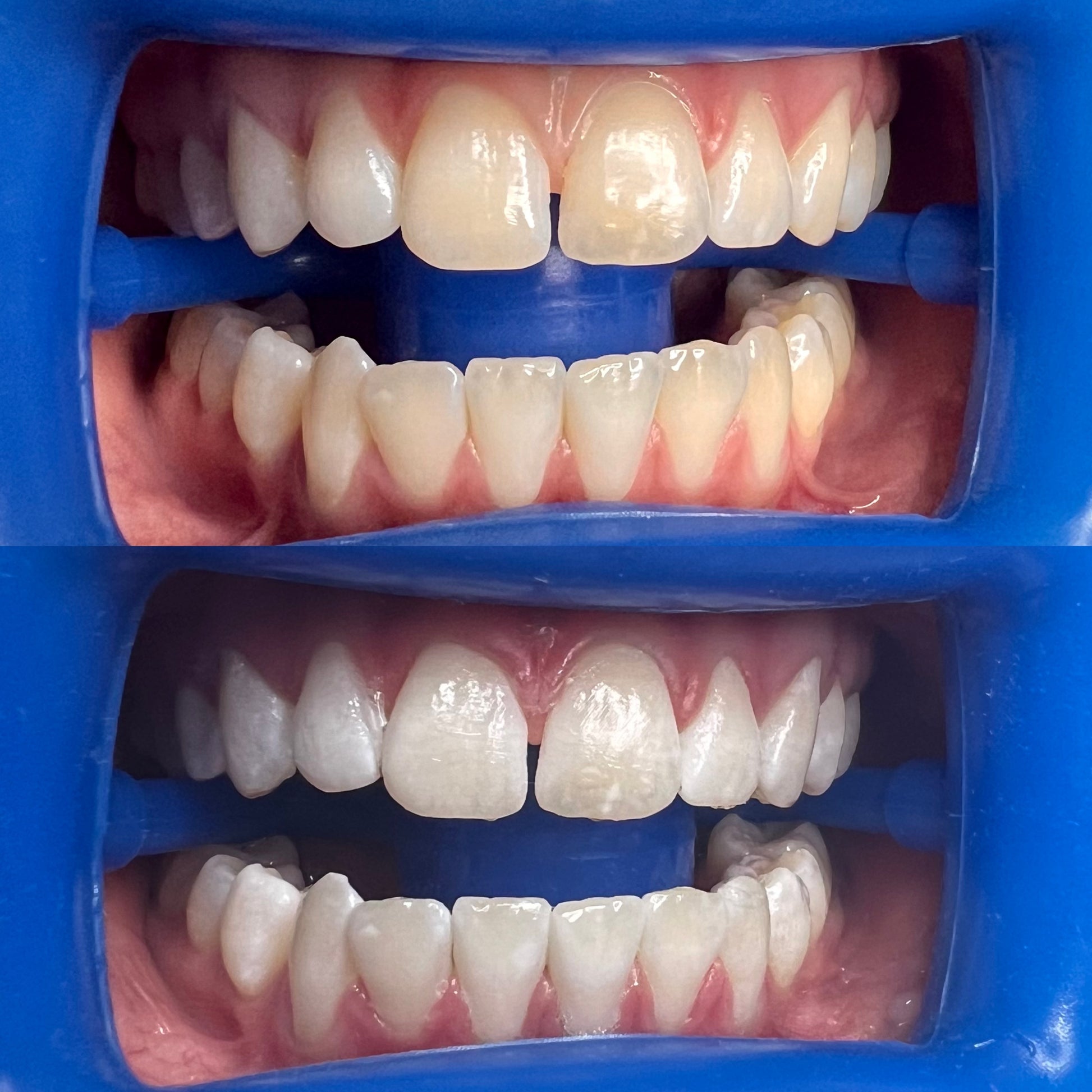 teeth whitening pens, professional whitening pens Australia, hydrogen peroxide whitening pen, teeth whitening supplies