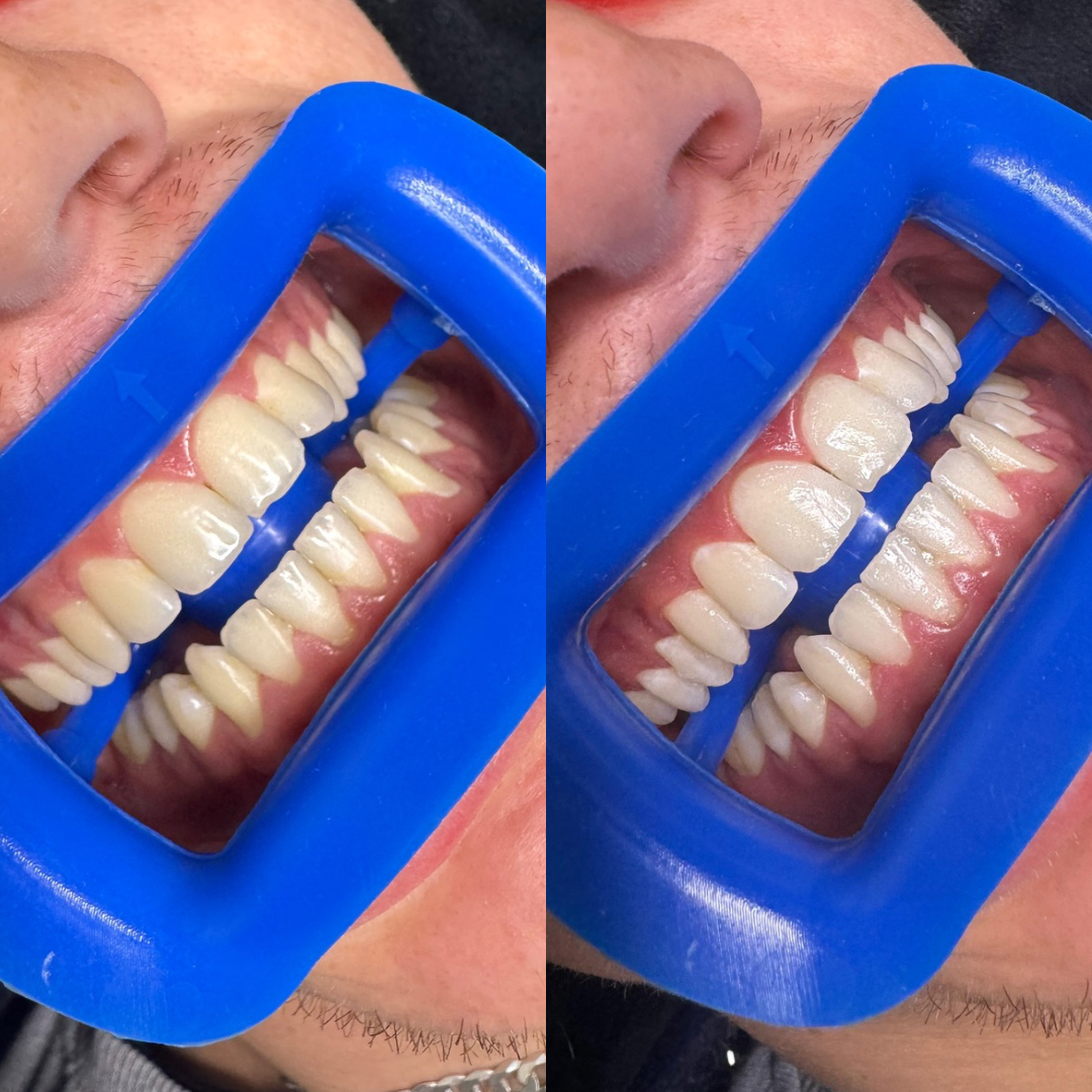 teeth whitening pens, professional whitening pens Australia, hydrogen peroxide whitening pen, teeth whitening supplies