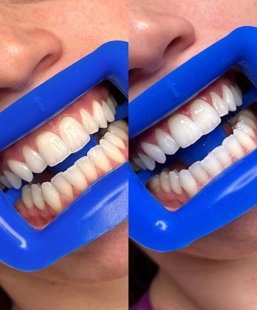 teeth whitening pens, professional whitening pens Australia, hydrogen peroxide whitening pen, teeth whitening supplies